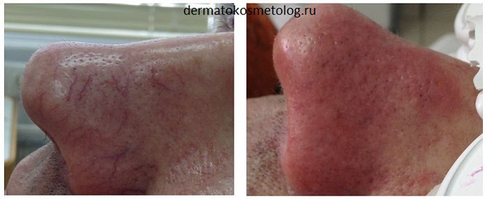 Фото до и после удаления сосудов неодимовым лазером (врач Соловых Н.А.)
